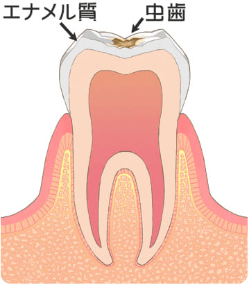 虫歯の初期「C1」
