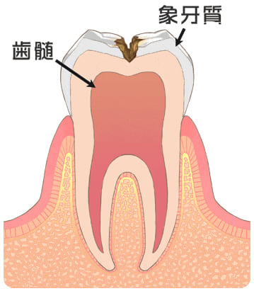 虫歯の中期「C2」