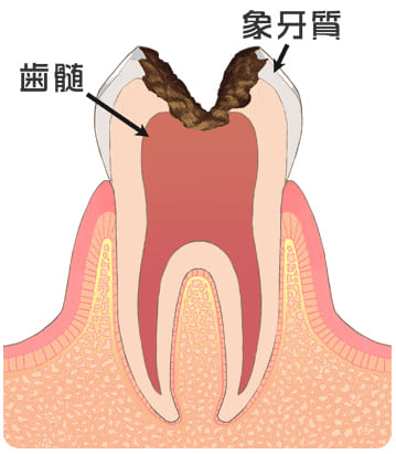 虫歯の後期「C3」
