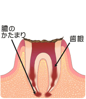 虫歯の末期「C4」
