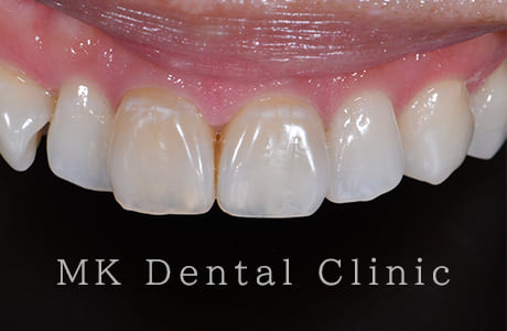 ホワイトニング+ダイレクトべニア術前