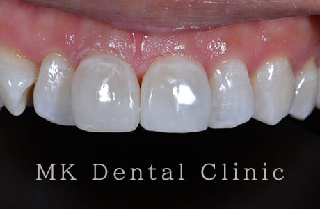 ホワイトニング+ダイレクトべニア術後