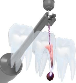 器具が届かない根管を殺菌する高周波